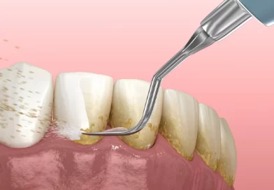 Harga Membersihkan Karang Gigi di Puskesmas dan Klinik Dokter Gigi